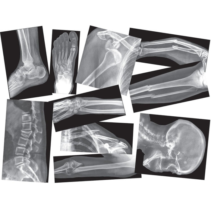 Broken Bones X-Ray Set, Pack of 15 - Kidsplace.store